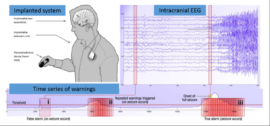 kaggle_seizure_1